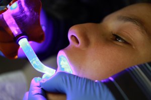 pic8  - Braces and Invisalign in San Jose California - Freeman Orthodontics