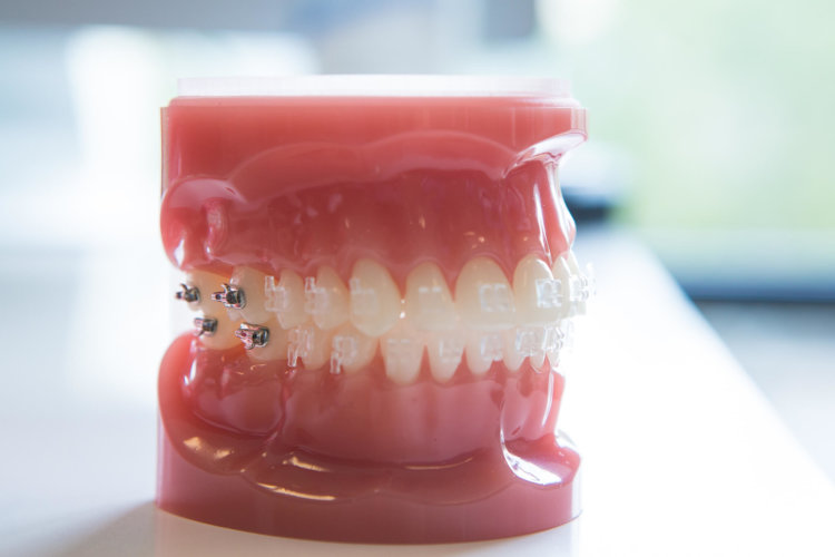 Freeman-Orthodontics-Clear-Braces-Treatment-34-thegem-gallery-metro 