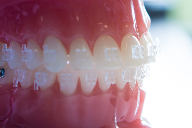 Freeman-Orthodontics-Clear-Braces-Treatment-35-thegem-gallery-metro 