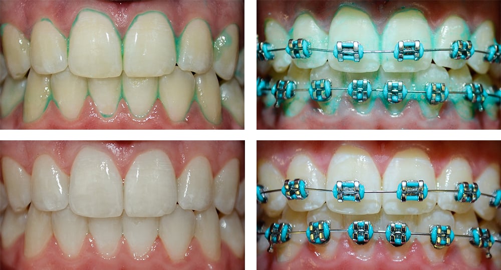 Teeth  - Braces and Invisalign in San Jose California - Freeman Orthodontics