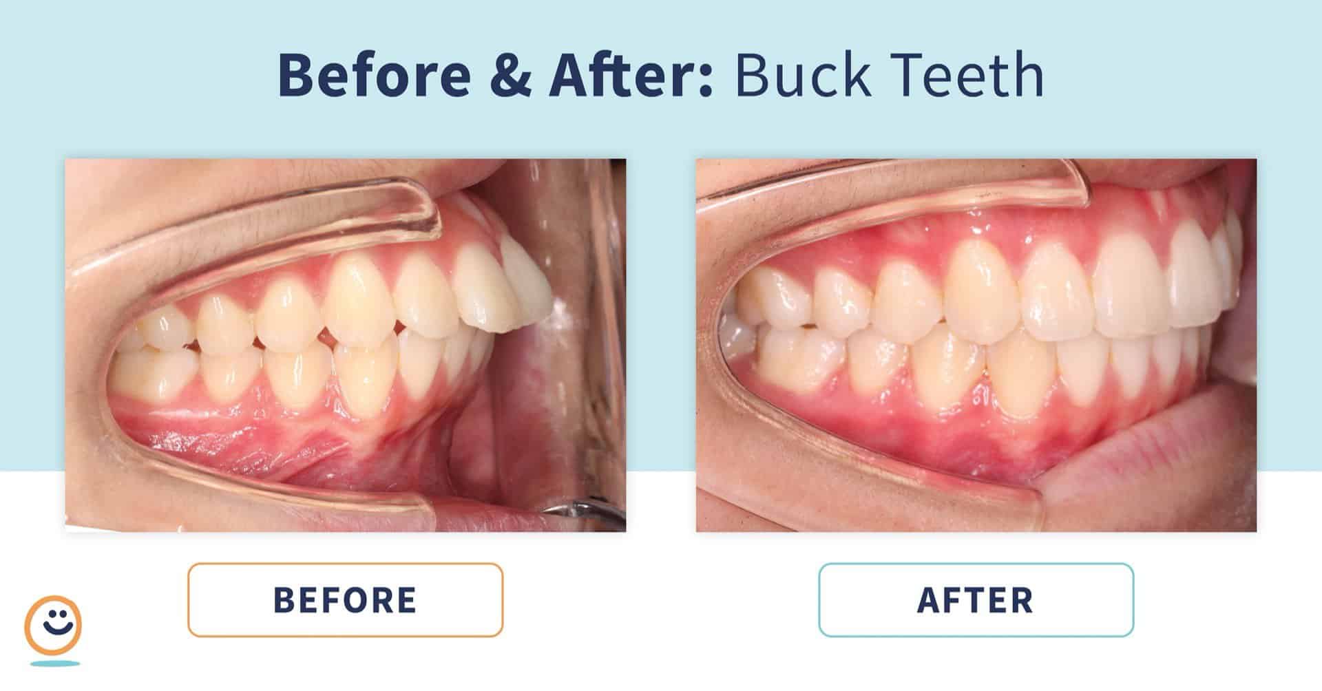 fo_BeforeAfter_BuckTeeth_1  - Braces and Invisalign in San Jose California - Freeman Orthodontics
