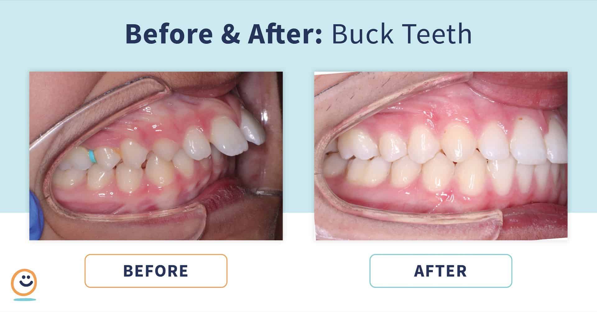 fo_BeforeAfter_BuckTeeth_2  - Braces and Invisalign in San Jose California - Freeman Orthodontics
